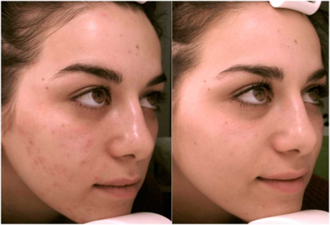 Peeling ácido Mandélico Antes E Depois Peelings médicos | TEMPUS